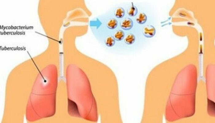 Taktik Pengobatan Crd Sebelum Gejala Bengkak Muncul