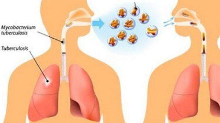 Taktik pengobatan CRD sebelum gejala bengkak muncul