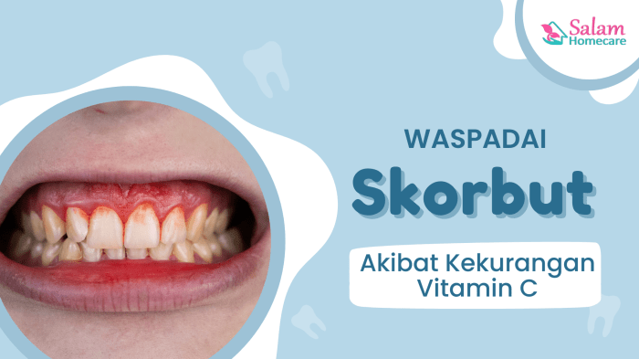 Penyakit unggas akibat kekurangan vitamin A